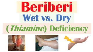 Beriberi Thiamine Deficiency Wet vs Dry Beriberi Pathophysiology Symptoms Diagnosis Treatment [upl. by Eriha]