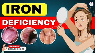 10 Weird Signs Youre Low on Iron  Iron Deficiency Anemia  Iron Deficiency Symptoms [upl. by Sairahcaz]