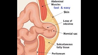 Femoral Umbilical amp Epigastric hernias [upl. by Nnylyar424]