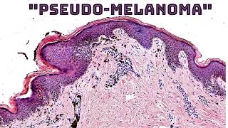 “PseudoMelanoma” recurrent nevus over scar after biopsy mimic of melanoma pathology dermatology [upl. by Jeff]