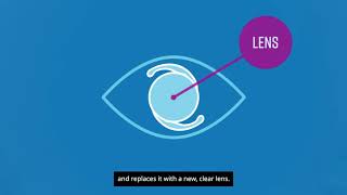 The PanOptix® Lens the first trifocal lens for cataract surgery [upl. by Naiviv999]