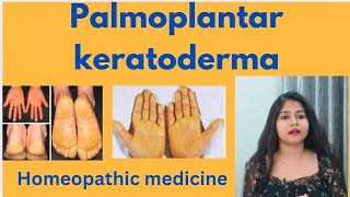 Palmoplantar keratoderma treatment  Palmoplantar keratoderma symptomscauses amp homeopathic medicine [upl. by Ygiaf]