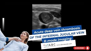 ACUTE DEEP VEIN THROMBOSIS OF THE INTERNAL JUGULAR VEIN BMODE IMAGING  ULTRASOUND [upl. by Leban]