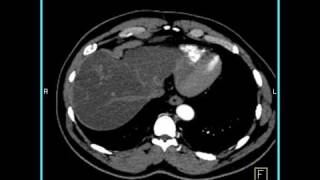 Abdomen Liver CT demonstrates a hemangioma of the liver because of the fatty infiltration1 of 10 [upl. by Lexie]