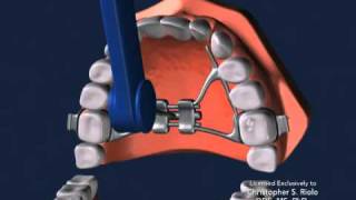 Seattle Orthodontist Dr Christopher Riolo Banded Expander RPE [upl. by Matthei]