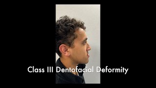 Bimaxillary Osteotomy and Genioplasty Part 1 [upl. by Airrej]