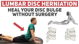 How to Heal Your Disc Herniation Without Surgery [upl. by Elfrieda]