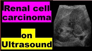 Renal cell carcinoma on Ultrasound [upl. by Ronym]