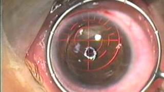 LASIK under General Anesthesia 2001  Jonathan M Davidorf MD [upl. by Delphina]