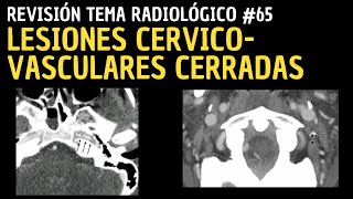 Revisión de Tema 65 Lesiones cervicovasculares cerradas [upl. by Hinkle37]