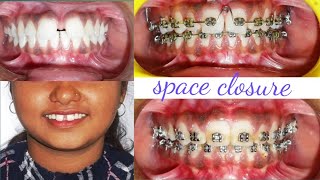 Large Midline Diastema Whats the best treatment shorts [upl. by Olemrac]