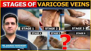 What are the stages of Varicose Veins   Dr Gaurav Gangwani Interventional Radiologist [upl. by Bonneau]