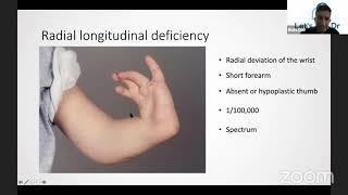 Congenital deformities of the Upper Limb [upl. by Hamil]