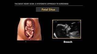 The Basic Fetal Heart Scan [upl. by Wendelina178]