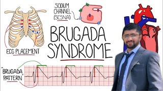 Brugada Syndrome ECG Brugada pattern Brugada pattern on ECG [upl. by Ketchum]