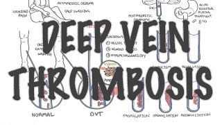 Deep Vein Thrombosis  Overview pathophysiology treatment complications [upl. by Dylane]