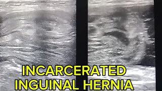 Incarcerated Inguinal Hernia What to Look For in ultrasound [upl. by Elyse]