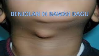 BENJOLAN DI BAWAH DAGU [upl. by Nawed169]