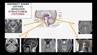 Brain herniation syndromes [upl. by Inalaehon]