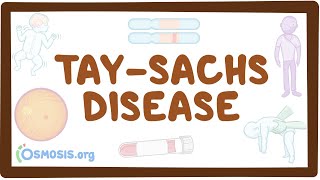 TaySachs disease  causes symptoms diagnosis treatment pathology [upl. by Bekha]