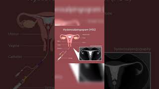 Hysterosalpingography  Salpingitis  Fallopian tube blockage  Nodular diverticulaeInfertility [upl. by Tabatha]