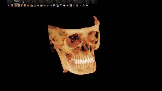 Dense bony island or idiopathic osteosclerosis  Wheaton dentist [upl. by Nivan]