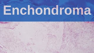 What are Enchondromas  Pathology mini tutorial [upl. by Breen376]