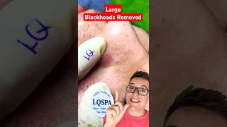 CRAZY BLACKHEAD REMOVAL  Huge Blackheads On Nose shorts [upl. by Armelda]