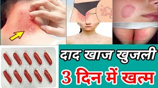 भयंकर से भयंकर खुजली मात्र 3 दिन में खत्मItching treatment दाद खाज खुजली चर्म रोग से छुटकारा [upl. by Rind230]