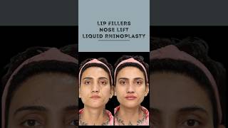 Transform Your Look Nose Lift amp Lip Fillers  Sarayu Clinics beauty [upl. by Norene]