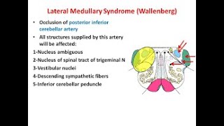 Lateral Medullary syndrome of wallenberg and signs and symptoms [upl. by Now]