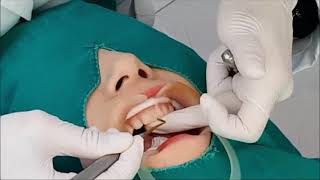 앞니레진 앞니레진 실시간 치료설명 Diastema resin closure real time anterior direct resin treatment [upl. by Anaerb]