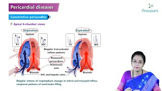 Pericardial Disease Hindi  Etiology Clinical Features Diagnosis Treatment and Complications [upl. by Andre726]