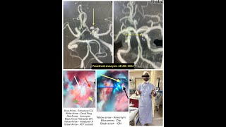 Paraclinoid ICA Aneurysm Clipping Anterior Clinoid Drilling  Meningo orbital band  Neurosurgery [upl. by Alleris]