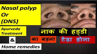 Naak Ki Haddi Ka Badna  आयुर्वेद इलाज  Symptoms amp Medicines  naak ki haddi badhne se kya hota hai [upl. by Sharona]