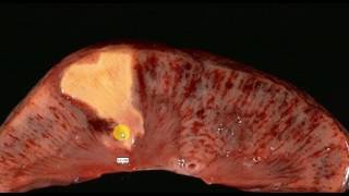 PATHOLOGY LECTURES  Hemodynamic Disorder  INFARCT [upl. by Sualocin212]