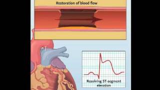 NEJM Procedure Primary PCI for Myocardial Infarction with STSegmented Elevation [upl. by Irv853]