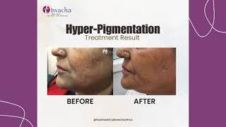 Hyper Pigmentation l Dark Spots l Sun Damage l Skin Treatments l Twacha l Dwarka l Delhi [upl. by Nyvrem26]