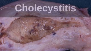 Cholecystitis and Strawberry Gallbladder  Pathology mini tutorial [upl. by Chapland]