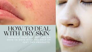 How to deal with dry skin in winters DimedZ lotion  Medicated formuladry to normal skin in days [upl. by Ane]