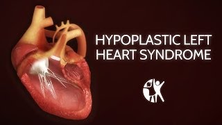 Hypoplastic Left Heart Syndrome HLHS [upl. by Aneek12]