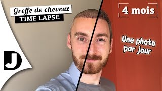 GREFFE de CHEVEUX Mon évolution après 4 MOIS  timelapse 🤳🏼 [upl. by Nicola]