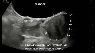 Gynaecology Ultrasound Quiz 1  2 Interesting cases [upl. by Lehcear843]