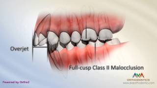 Malocclusion  Class II Div I [upl. by Angelita200]