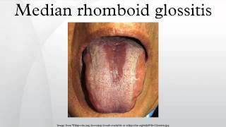 Median rhomboid glossitis [upl. by Birkner]