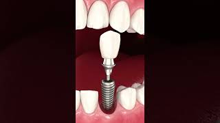 Dental Implants the gold standard solution for missing teeth 🙌 ruhdental newsmile implants [upl. by Horst]