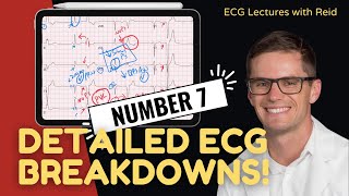 EKG Test Yourself  ECG Case Study 7 [upl. by Brennen]