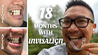 18 MONTHS TEETH MOVEMENT PROGRESS WITH INVISALIGN  Invisalign Journal [upl. by Hametaf]