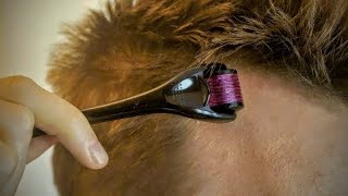 Derma roller for hair regrowth  Hair care video howto vlog [upl. by Reamonn729]