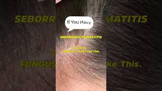 Seborrheic Dermatitis How to treat your Scalp itchyscalp shorts dandruff seborrheicdermatitis [upl. by Grayce]